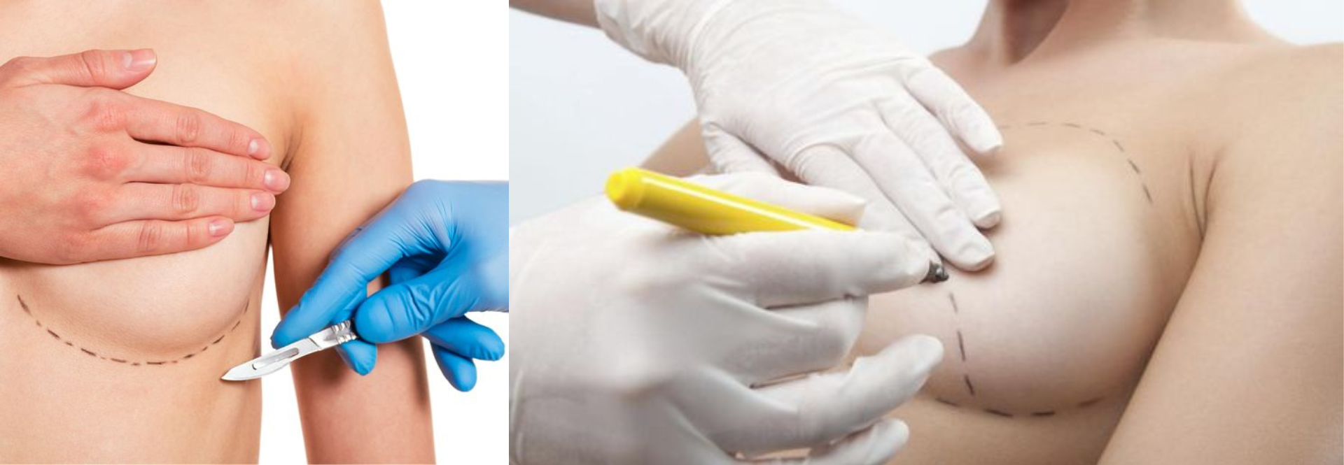 PHẪU THUẬT NÂNG NGỰC CÓ ĐỂ LẠI SẸO  ?